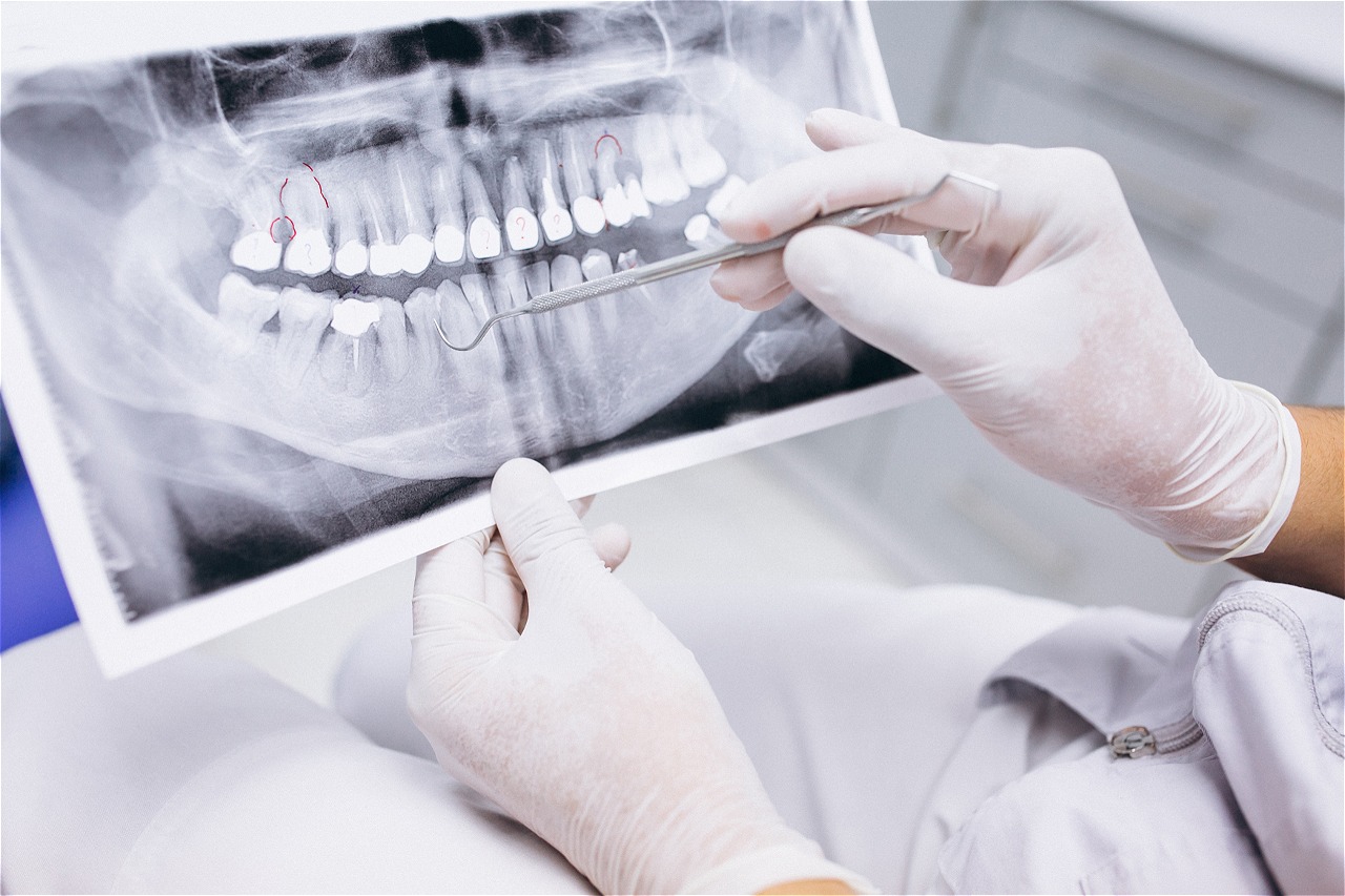 x-ray-of-teeth.jpg