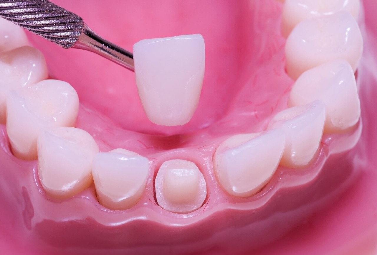 Этапы восстановления зуба коронкой: